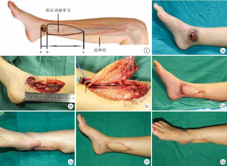 保留感觉的胫后动脉穿支皮瓣v-y推进修复踝周创面