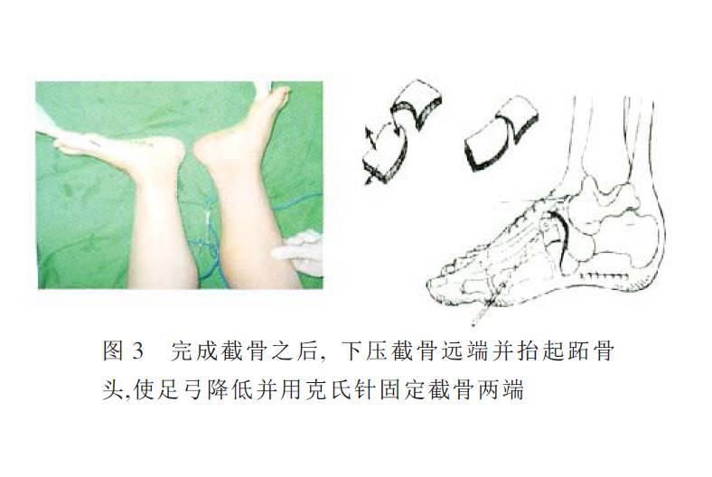 【手术演示】跗骨v形截骨术治疗儿童高弓足或高弓内翻足
