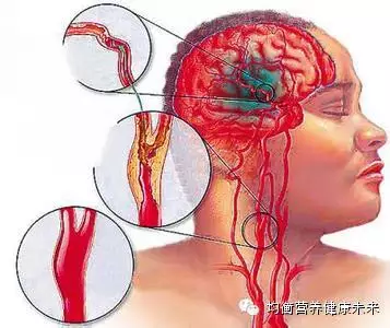 脑梗和脑溢血是怎么发生的 - 金鑫 - 金鑫的博客 脑梗和脑溢血是怎么发生的 - 一炮手 - 一炮手的杂志型编撰博客