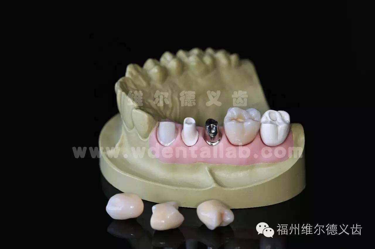 维尔德义齿biohpp产品系列