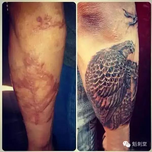 爱美之心人皆有之,可不管是烧伤烫伤留下的疤痕还是各种手术留下的