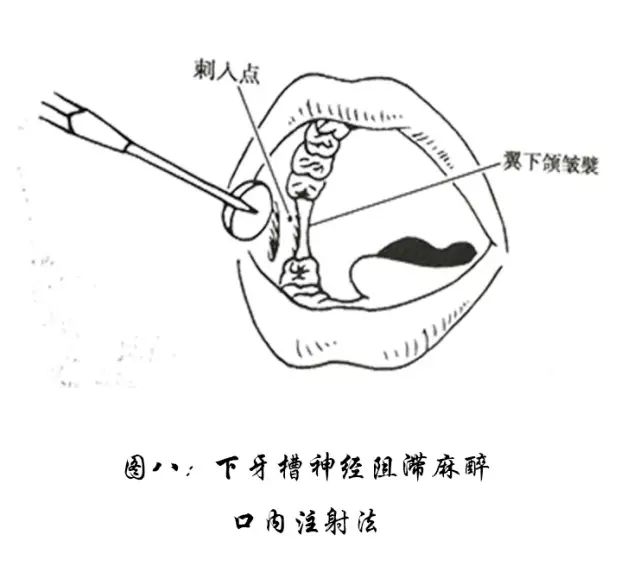 干货分享丨口腔局部麻醉技术概要,小伙伴都偷偷收藏起来了!