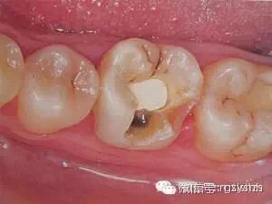 2.牙齿缺钙