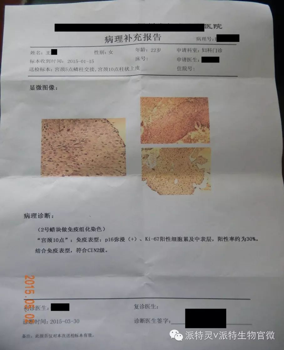 【病例分享】高危型hpv16型,cin2,使用派特灵转阴!