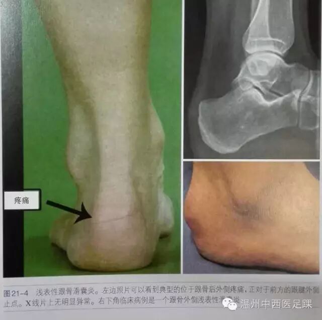 止点性跟腱炎,haglund畸形与跟腱滑囊炎