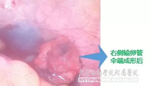 【健康科普】一次药物流产七年输卵管积水,微创助孕后一月成功怀孕-怀孕期