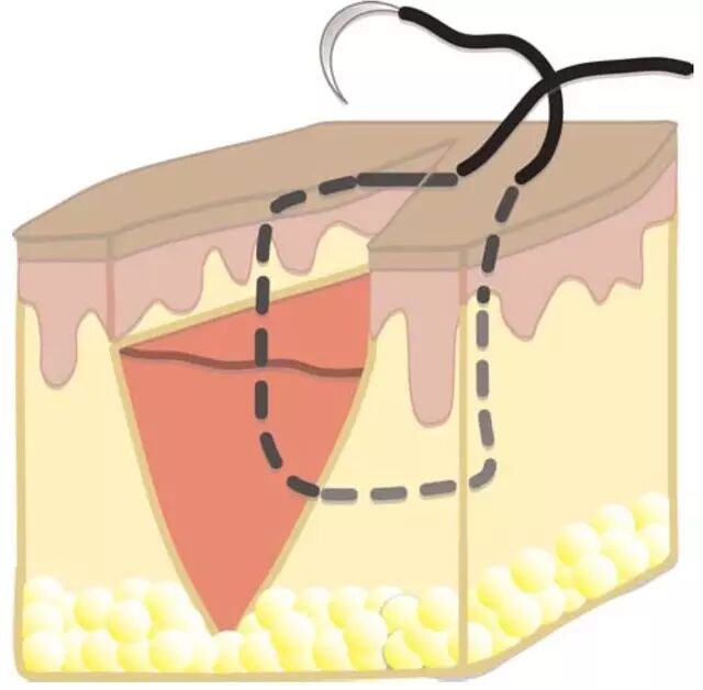 为什么要用皮钉缝合详细、实用：骨科手术切口管理（综述）_https://www.jmylbn.com_新闻资讯_第4张