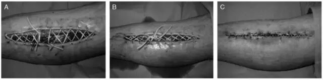 为什么要用皮钉缝合详细、实用：骨科手术切口管理（综述）_https://www.jmylbn.com_新闻资讯_第6张