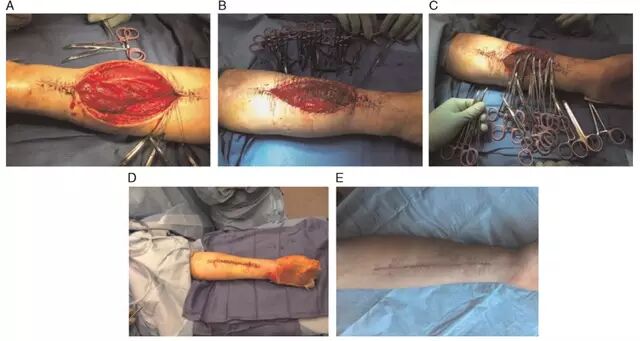 为什么要用皮钉缝合详细、实用：骨科手术切口管理（综述）_https://www.jmylbn.com_新闻资讯_第5张