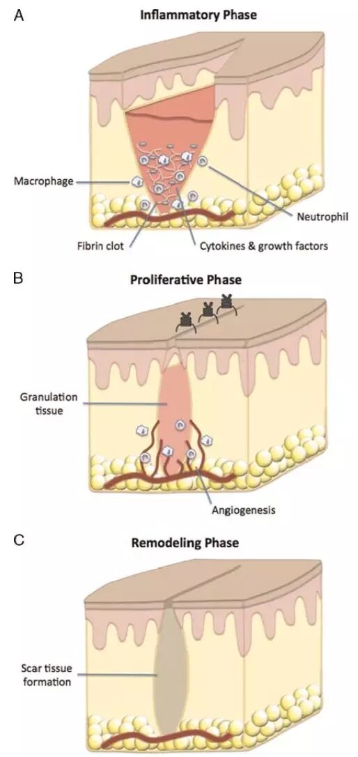 为什么要用皮钉缝合详细、实用：骨科手术切口管理（综述）_https://www.jmylbn.com_新闻资讯_第1张