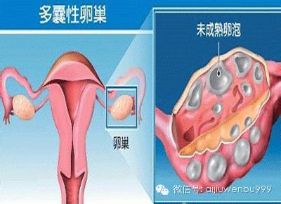 健康指导  1,用避孕药抑制排卵,可通过阻止卵泡形成而预防卵巢囊肿.