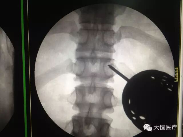 c臂怎么启动全智能型疼痛科／介入型C型臂_https://www.jmylbn.com_新闻资讯_第3张