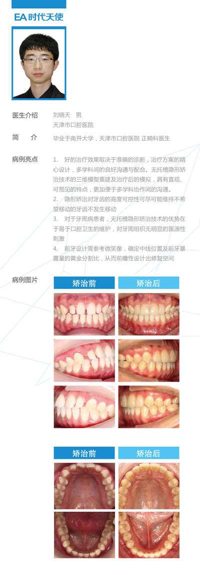 右侧磨牙远中关系,上下牙列中度拥挤,深覆盖,17-47正锁颌.