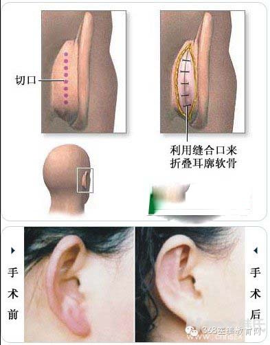 20140627一例招风耳手术对比图_整形刘波教授_新浪博客