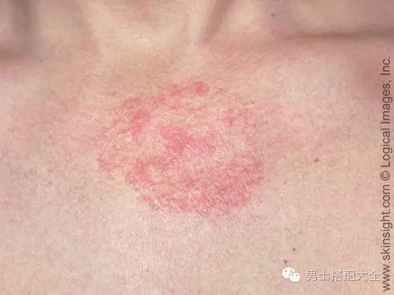 护肤| 男人常见的五种皮肤毛病 护肤| 男人常见的五种皮肤毛病