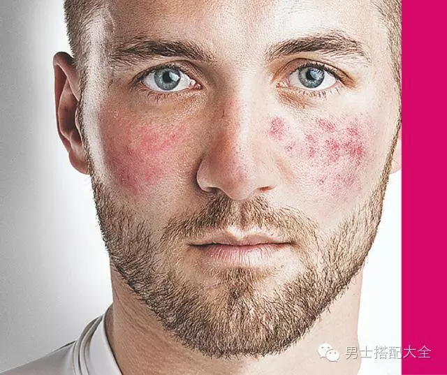 护肤| 男人常见的五种皮肤毛病