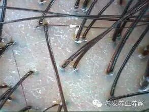 头皮好，头发好！关爱头发必须关爱头皮！