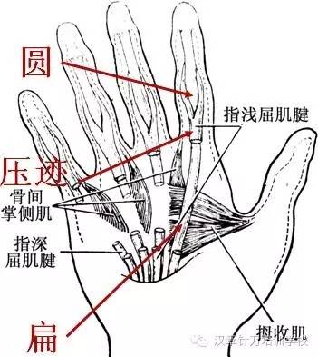 针刀治疗屈指肌腱狭窄性腱鞘炎这个病小但最能体现你的针刀水平