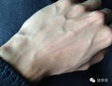 人体"青筋"凸起 到底是为什么