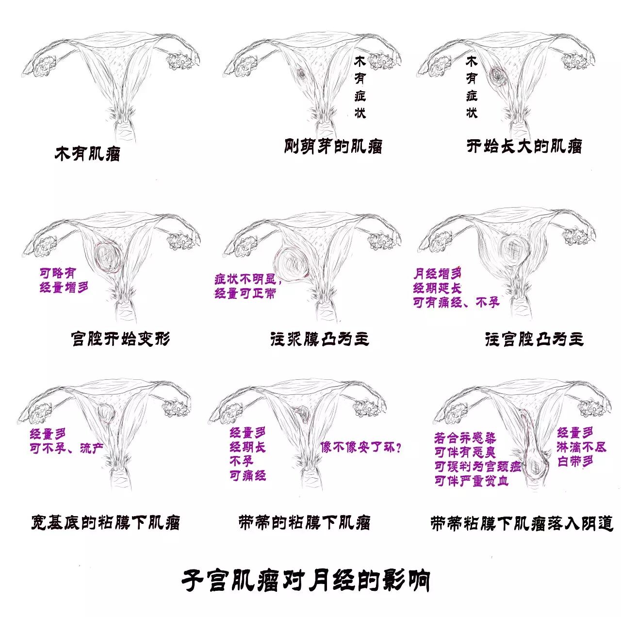 子宫肌瘤与怀孕之间的纠葛 (原创)