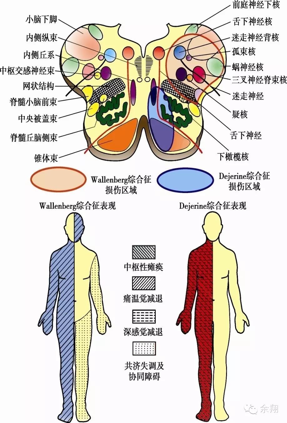 syndrome)①眩晕,恶心,呕吐及眼震(前庭神经核)②病灶侧软腭,喉咽肌