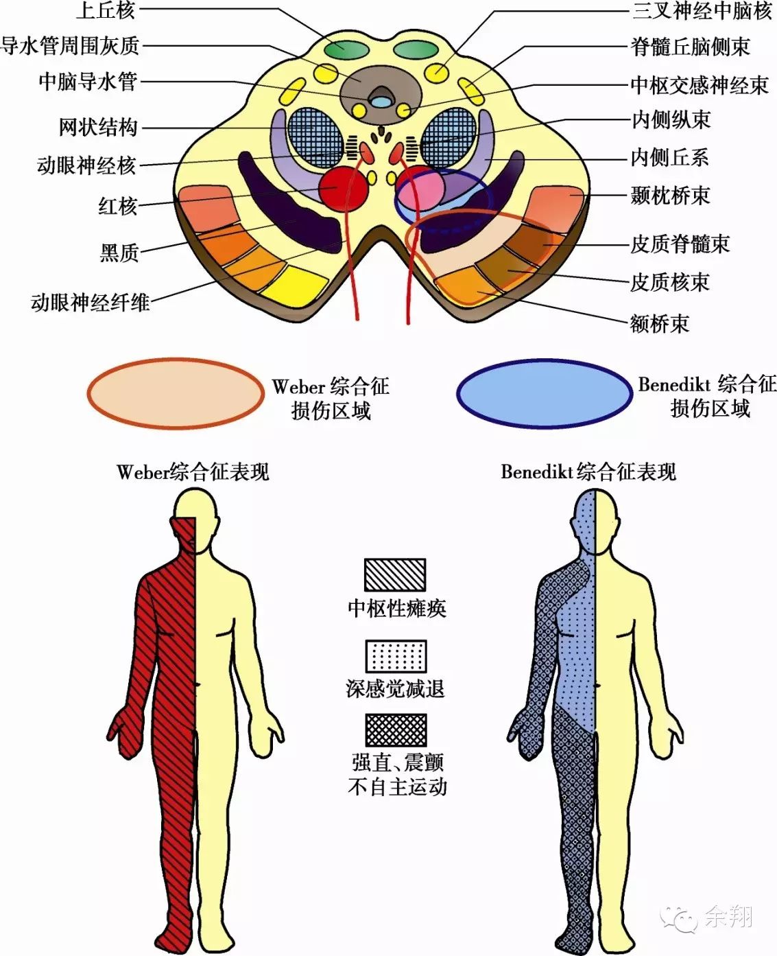 中脑: 1)大脑脚综合征(weber)动眼神经交叉瘫①患侧出外直肌和上斜肌