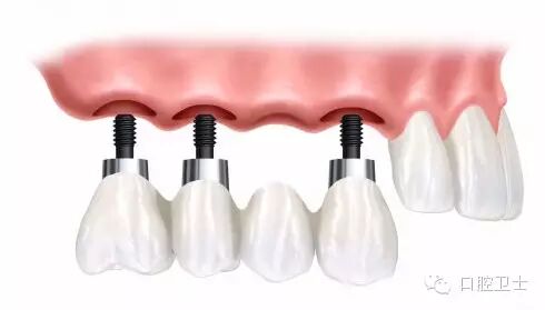 种植牙的适应症和禁忌症