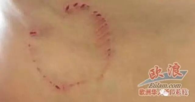 西班牙benidorm10岁男孩海滩被未知鱼类咬伤