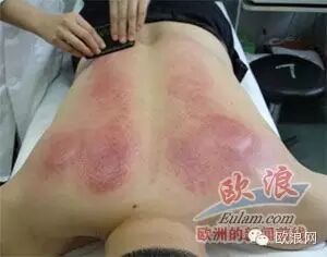 真实版刮痧在西班牙上演 华人母亲为儿子刮痧遭警方拘捕
