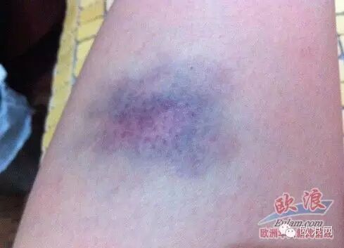 巴塞女侨胞被打案后续——被打华人女子欲起诉公园恶霸