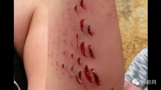 一名西班牙女性海边被鲨鱼咬伤