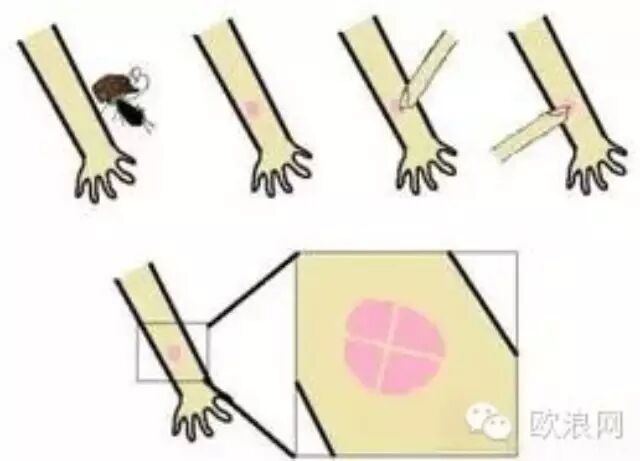 掐“十”字能止痒？教你管用的止痒妙方~