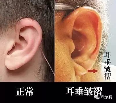 【健康】小心！耳朵上发现有这个东西，很可能有冠心病！