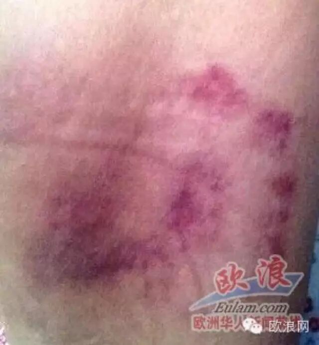 西华人大妈路上遭辱骂“中国婊子”与对方发生争执后遭咬伤