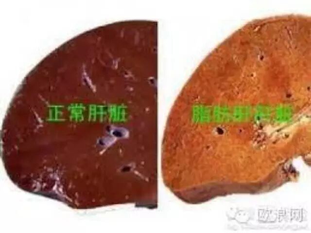 【健康】脂肪肝可逆转！如果你身边有脂肪肝患者，请将逆转方法告诉TA