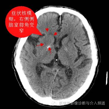 教你看懂超急性期脑梗塞ct征象