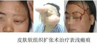 认知皮肤扩张术 