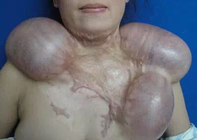 认知皮肤扩张术 