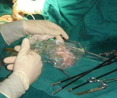 认知皮肤扩张术 