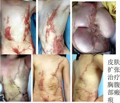 认知皮肤扩张术 