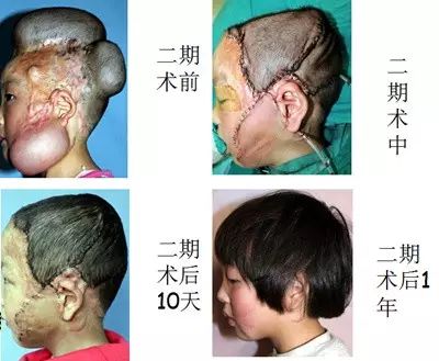 认知皮肤扩张术 