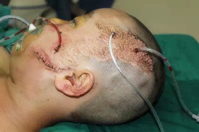 认知皮肤扩张术 