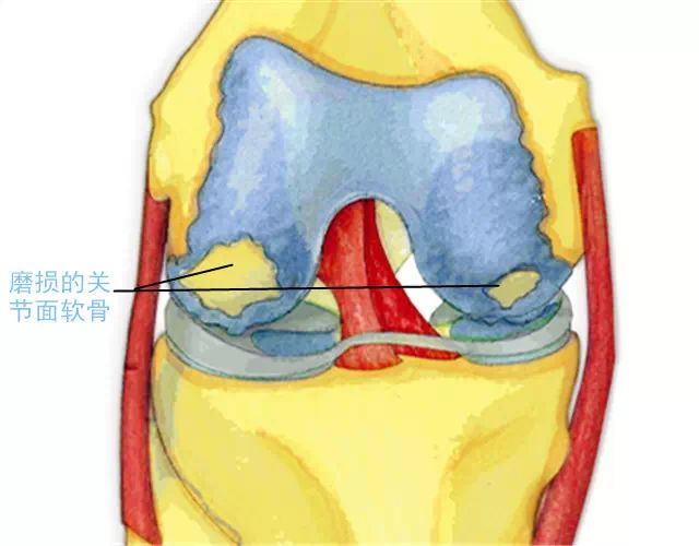 图解膝关节的构造和全膝关节置换手术