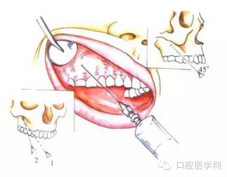 口内注射法【上牙槽后神经阻滞麻醉】78眶下裂后方射法77过程:刺