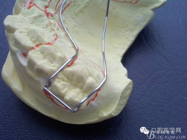活动矫治器的弯制方法分牙簧双曲舌簧卡环