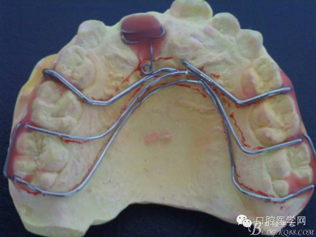 活动矫治器的弯制方法分牙簧双曲舌簧卡环