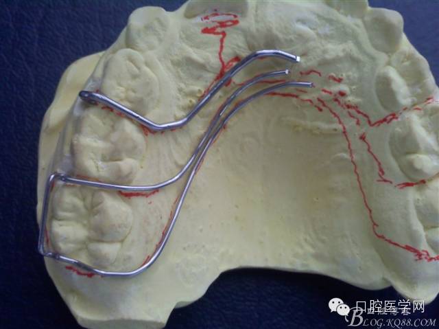 活动矫治器的弯制方法分牙簧双曲舌簧卡环