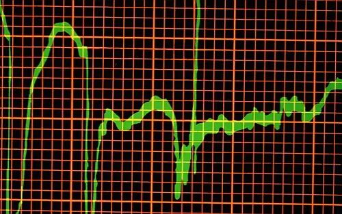 年轻人心脏性猝死与基因有关