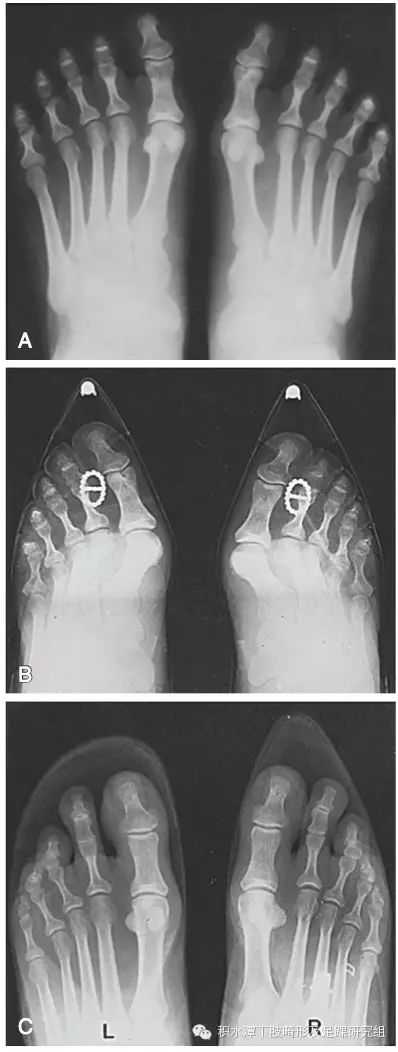 除此以外,还可能发生二,三,四等其它脚趾的症状,如脚趾屈曲变形的锤状