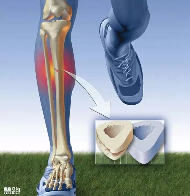 为什么跑步小腿会痛 <wbr>——胫骨内侧应力综合征完全康复方案-1